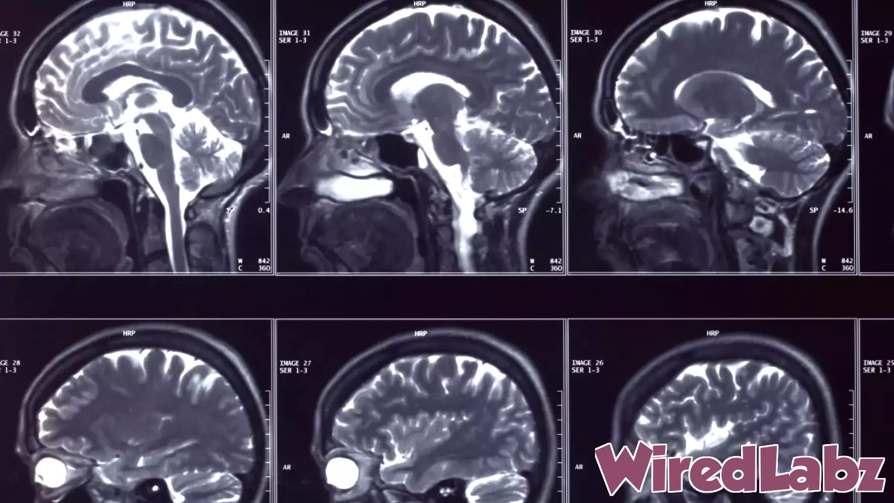 A brain implant to treat depression gets FDA greenlight to start trials
