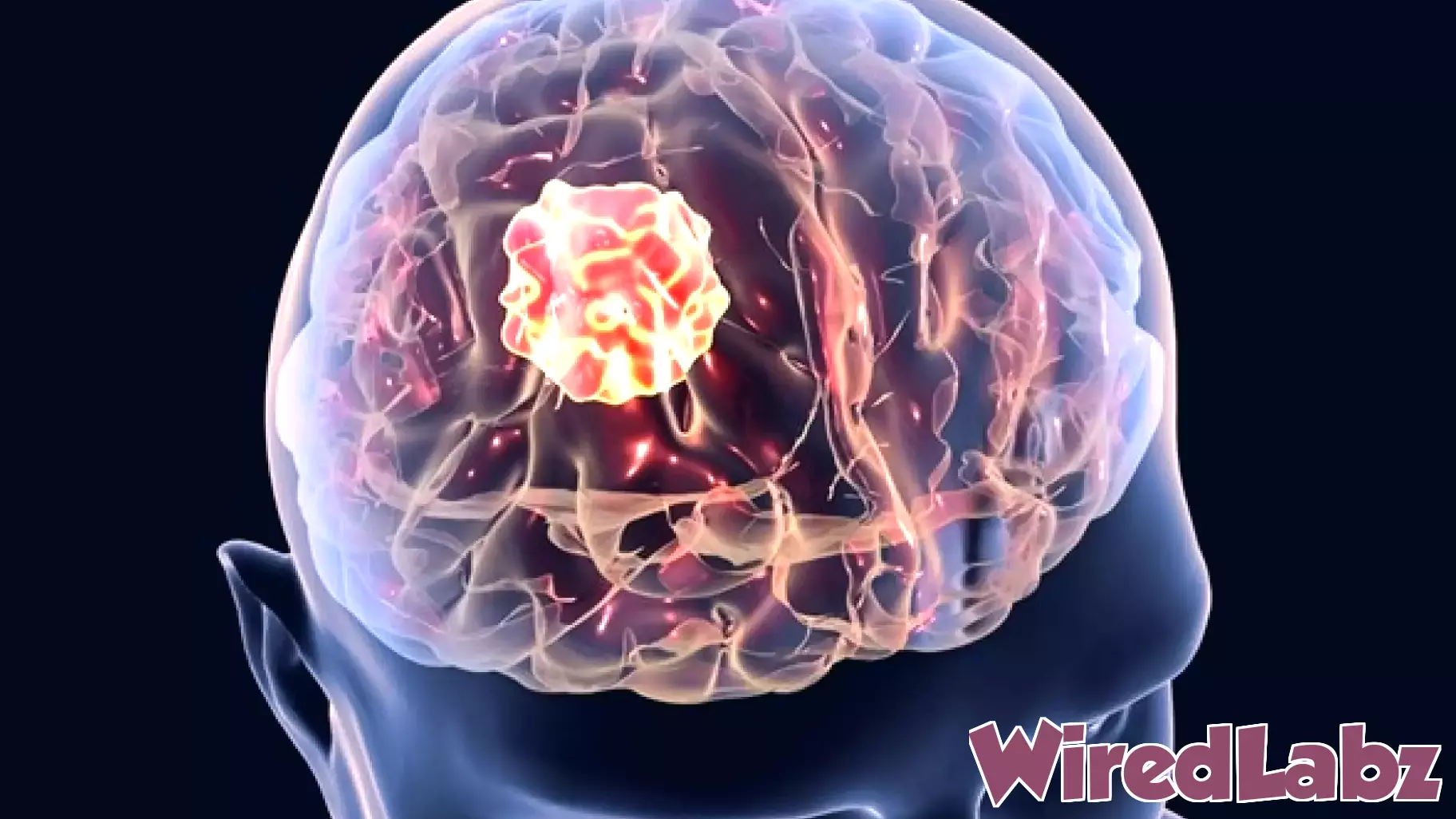 Advancements in AI Technology Boost Early Detection of Glioblastoma Progression