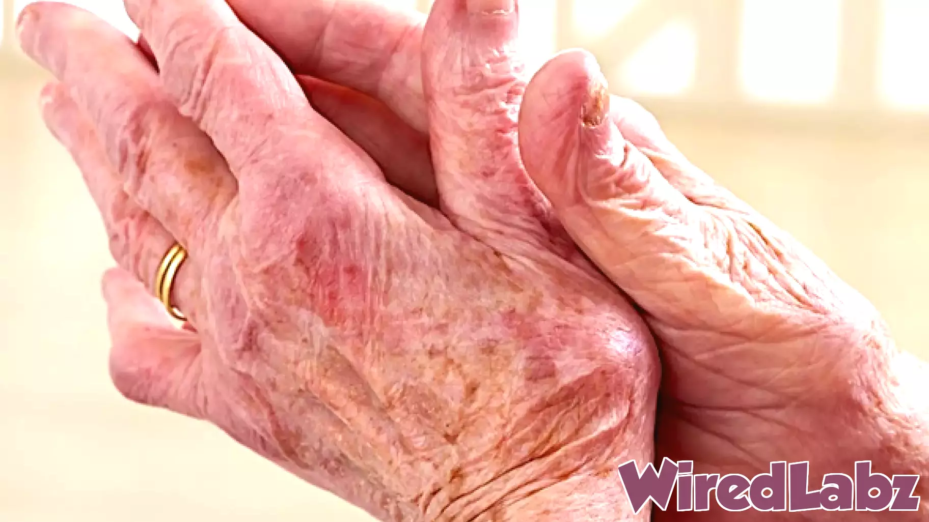 Rapid Diagnosis of Arthritis Using Synovial Fluid