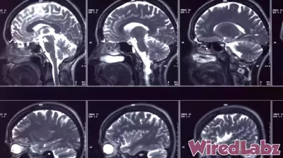 A brain implant to treat depression gets FDA greenlight to start trials